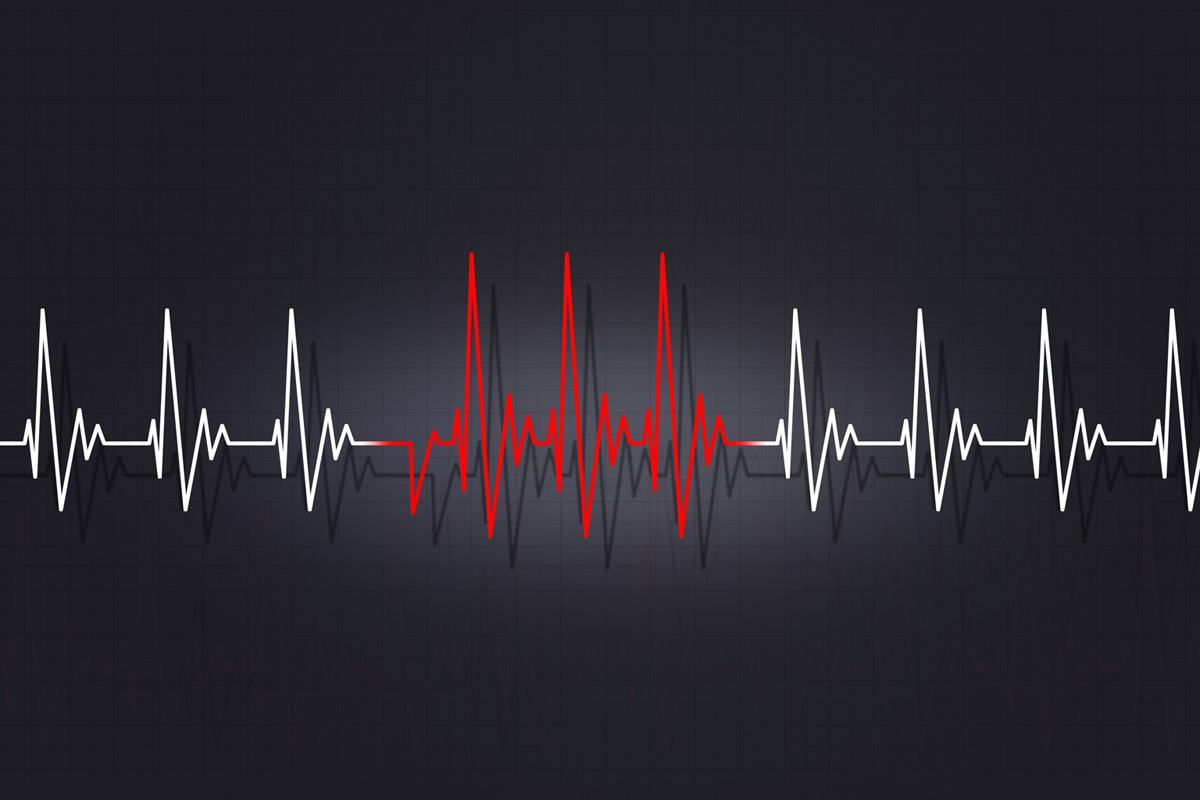 Atrial Fibrillation and Heart Rhythm Abnormalities